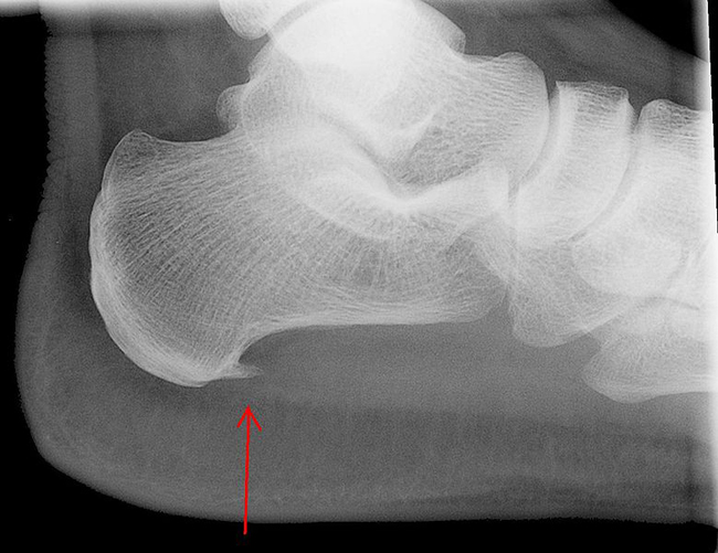 An Xray view of a heel spur; image courtesy Lucien Monfils